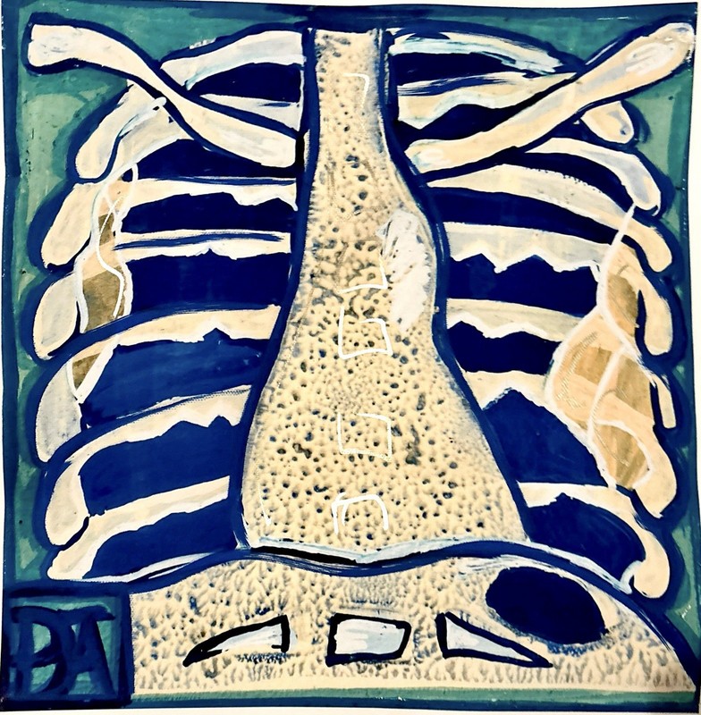 Neurofibromatosis Type 1 NF1 Heart Chest Xray Lungs Medical 30x30cm Canvas Print gallery